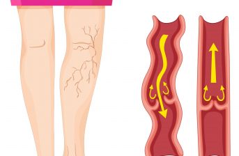 Come nascono i danni venosi? Dalle "Gambe pesanti" alla ...